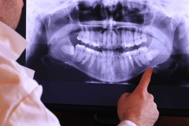 Best Emergency Treatment for Dental Infections or Abscesses in Stone Ridge, NY