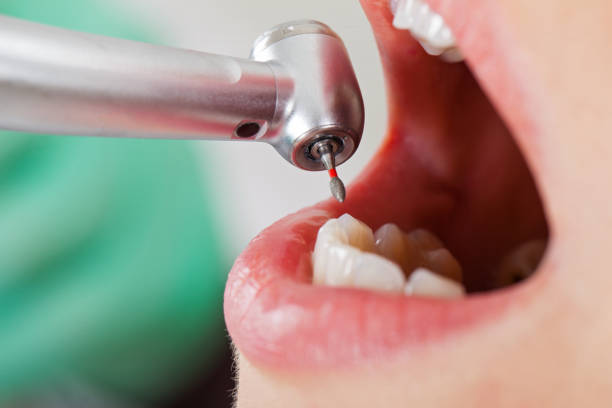 Best Emergency Treatment for Dental Infections or Abscesses in Stone Ridge, NY